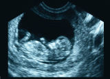 scan in womb